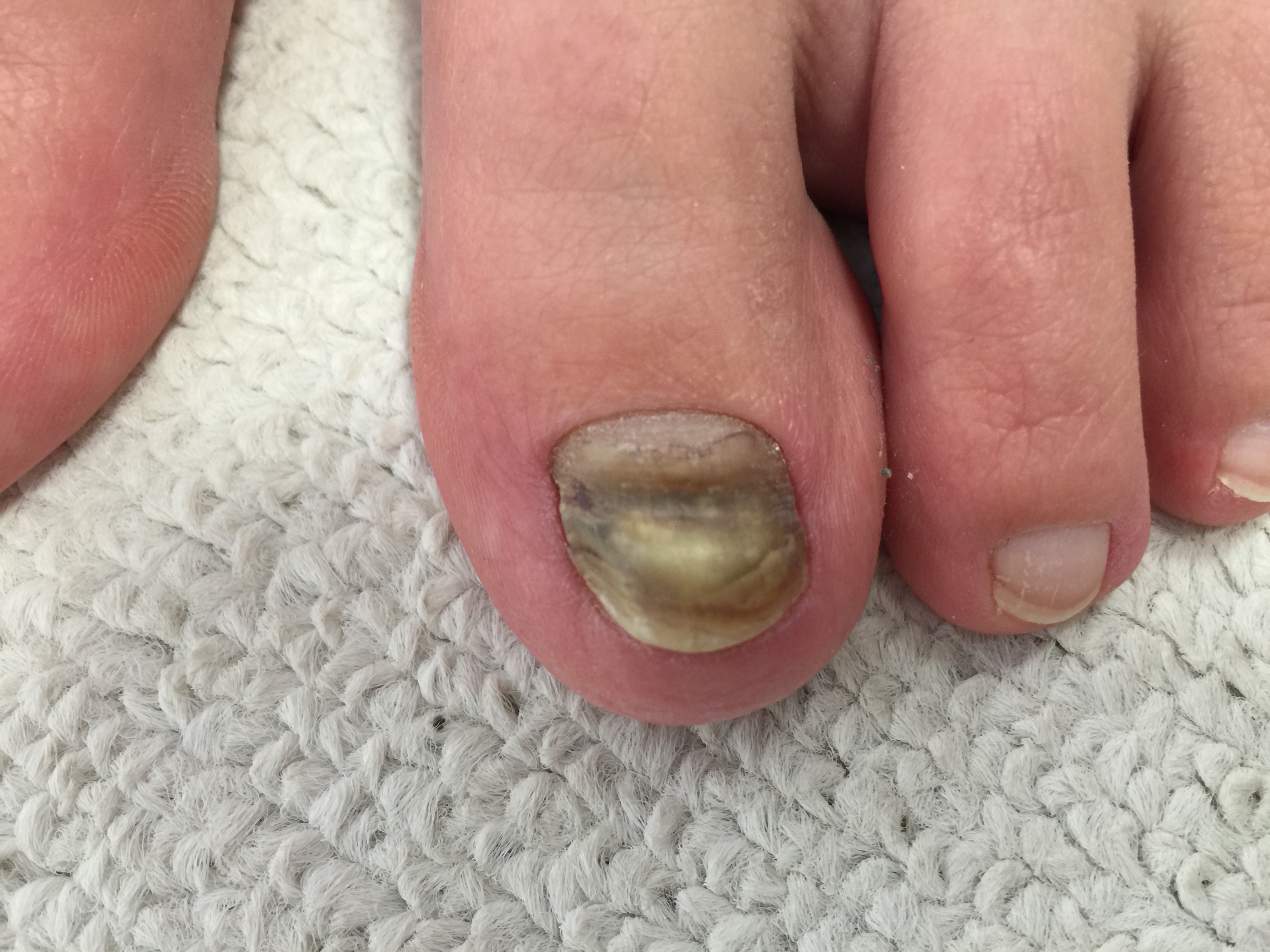 Makacs lábgomba - Bőrbetegségek