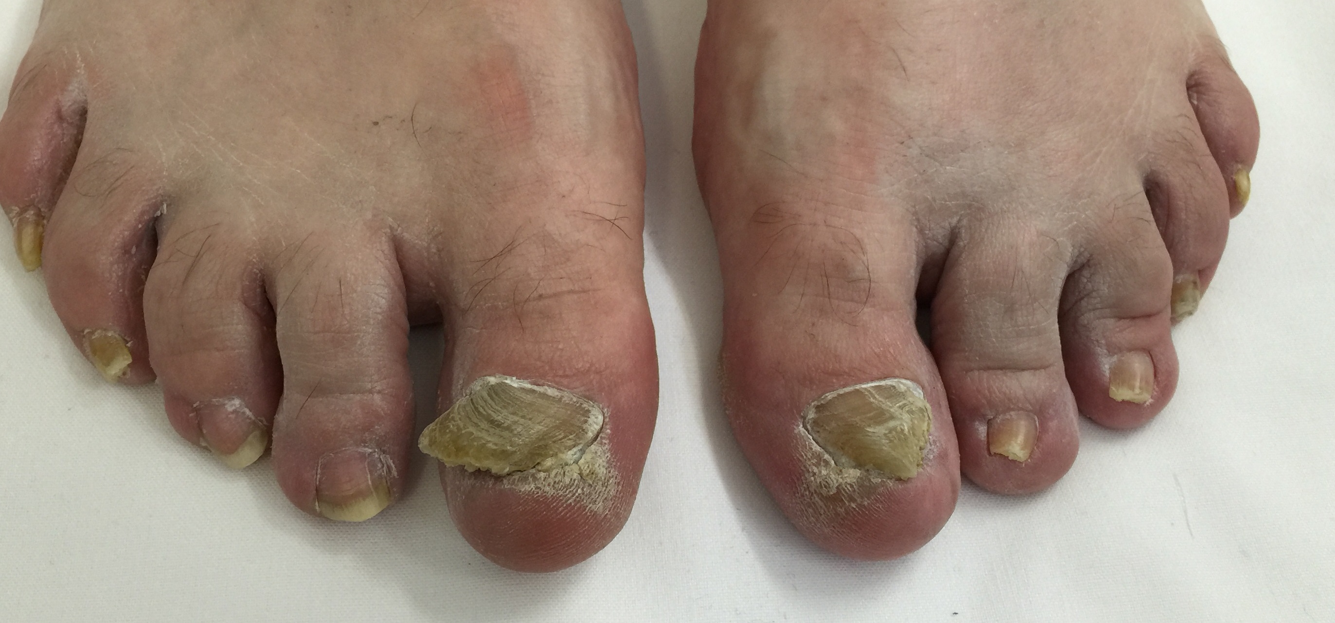gomba toenails név kenőcs eszköz kezelés körömgomba után